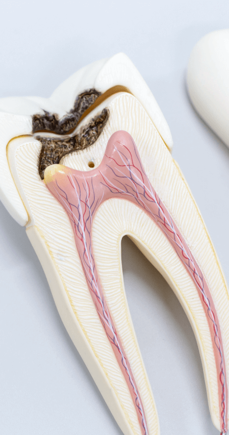 Benefits of Root Canals Treatment