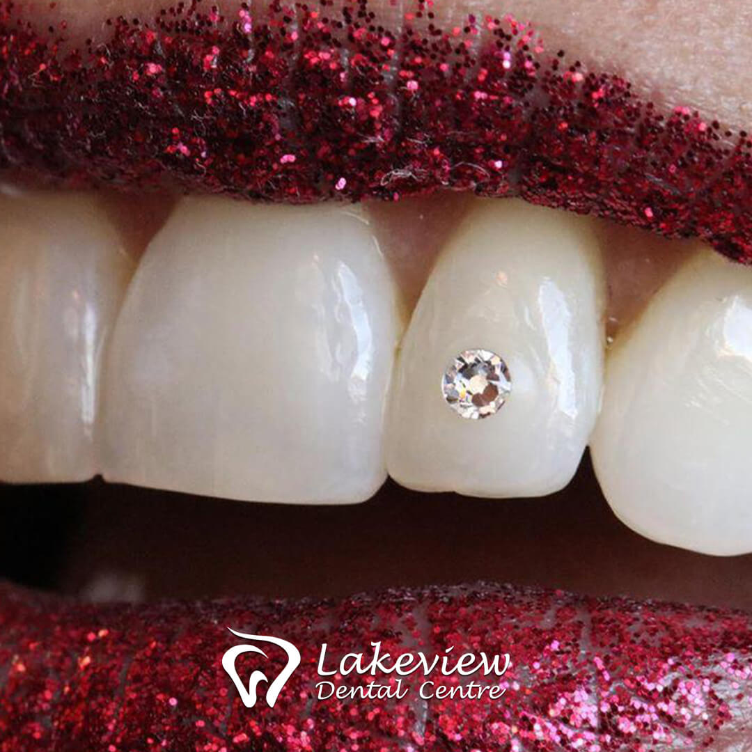 Dental tooth gems, sparkles and gold tooth jewelry? So much choice we have!