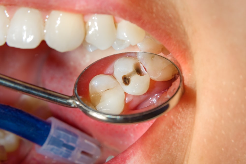 Cavities Treatment in Calgary